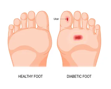 Diabetic foot ulcer