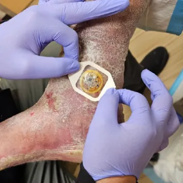 Smart Bandage used on diabetic foot ulcers